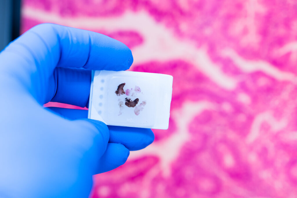 gloved hand holding malignant FFPE tissue samples with microscopic image in background