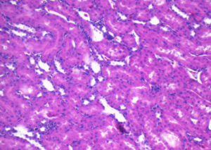 Microscope view of hematoxylin and eosin stained human carcinoma cells