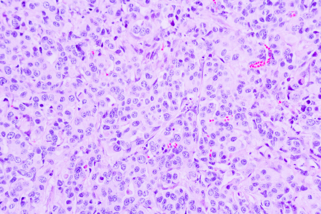 Microscopic view of human tissue sample showing predictive biomarkers for breast cancer