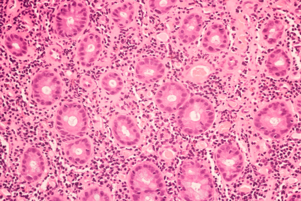 View in microscopic of ductal cell carcinoma, adenonocarcinoma from human breast cancer, tissue section by H and E stain.