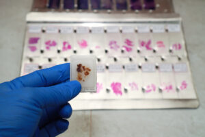 Human biospecimens provide the foundation of countless scientific discoveries, but not all providers offer the same level of quality, documentation, or support. From specimen preservation and pathology review to clinical annotation and regulatory compliance, researchers must evaluate several factors before choosing a source for biological materials. This guide explores what to look for when evaluating a biospecimen provider and why working with an established repository can help strengthen research outcomes.